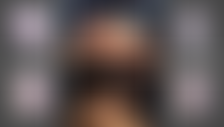 Fracturas bilaterales de tórax con tecnología 3D y técnica quirúrgica MARF