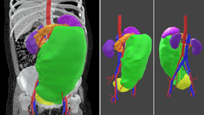 Planificación 3D virtual en cirugías multiviscerales por tumores gigantes