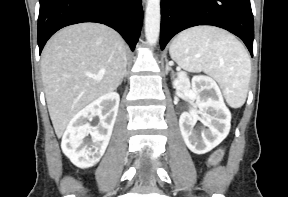 Urotomografía. Vista coronal
