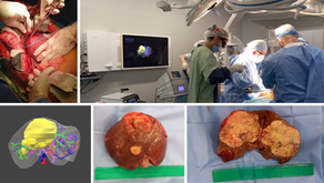 Tumores hepáticos navegados virtualmente con un modelo 3D anatómico