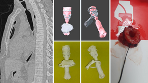 Planificación quirúrgica 3D para tratamiento de estenosis traqueal