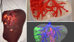 Resección de tumores hepáticos con biomodelos 3D