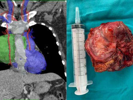 Timectomía radical con planificación quirúrgica virtual 3D