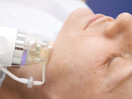 The Industry Heat Surrounding RF Microneedling
