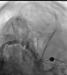 X-ray Picture taken during radiofrequency of Gasserian Ganglion