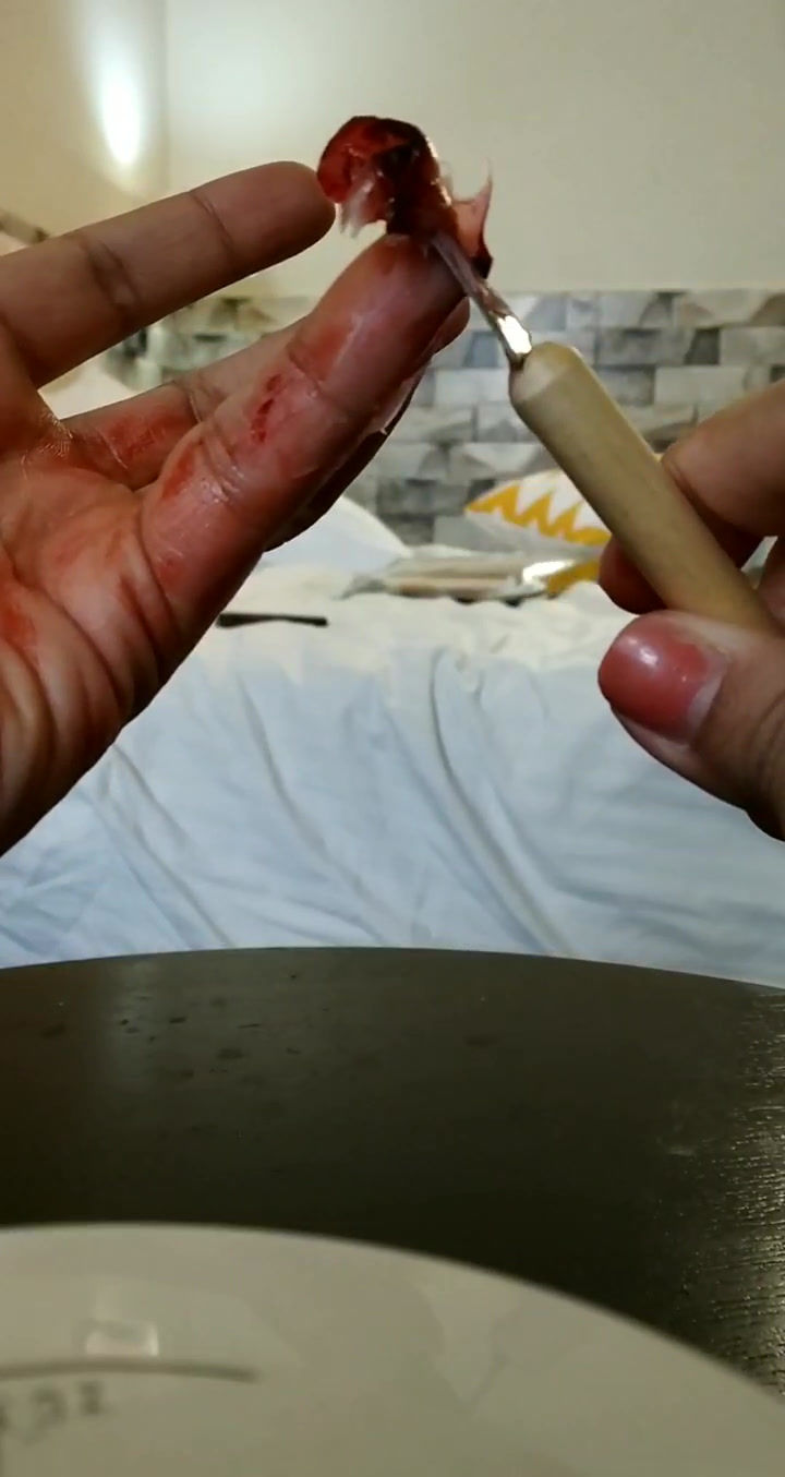 Thumbnail: Prosthetic Services