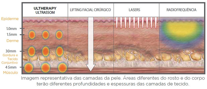 ULTHERAPY DR. EDUARDO BORNHAUSEN