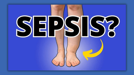 Alert! Foot/Ankle Swelling And Edema Can Cause Serious Sepsis; Know This