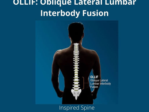 OLLIF: Oblique Lateral Lumbar Interbody Fusion