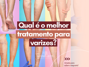 Qual é o melhor tratamento para varizes?