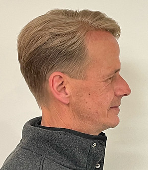 A side after image of a real male client with androgenetic alopecia, but now with full head hair.