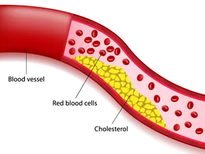 Dyslipidemia: The Silent Killer