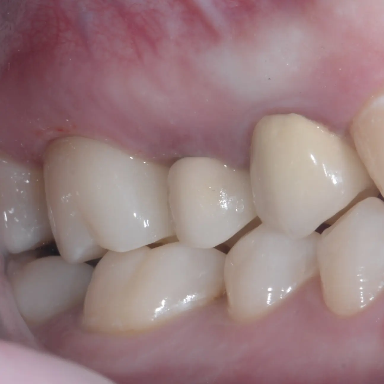 Immediiat Implantation IS-II - 6/10. Zirconium crown. 3 month after Implantation. content media