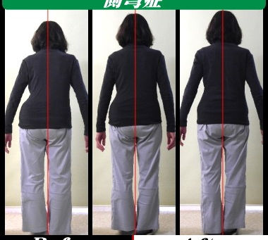 側弯症に対するカイロプラクティックアプローチ:症状を緩和し生活の質を向上