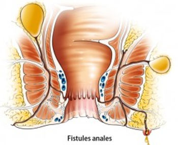 fistules anales