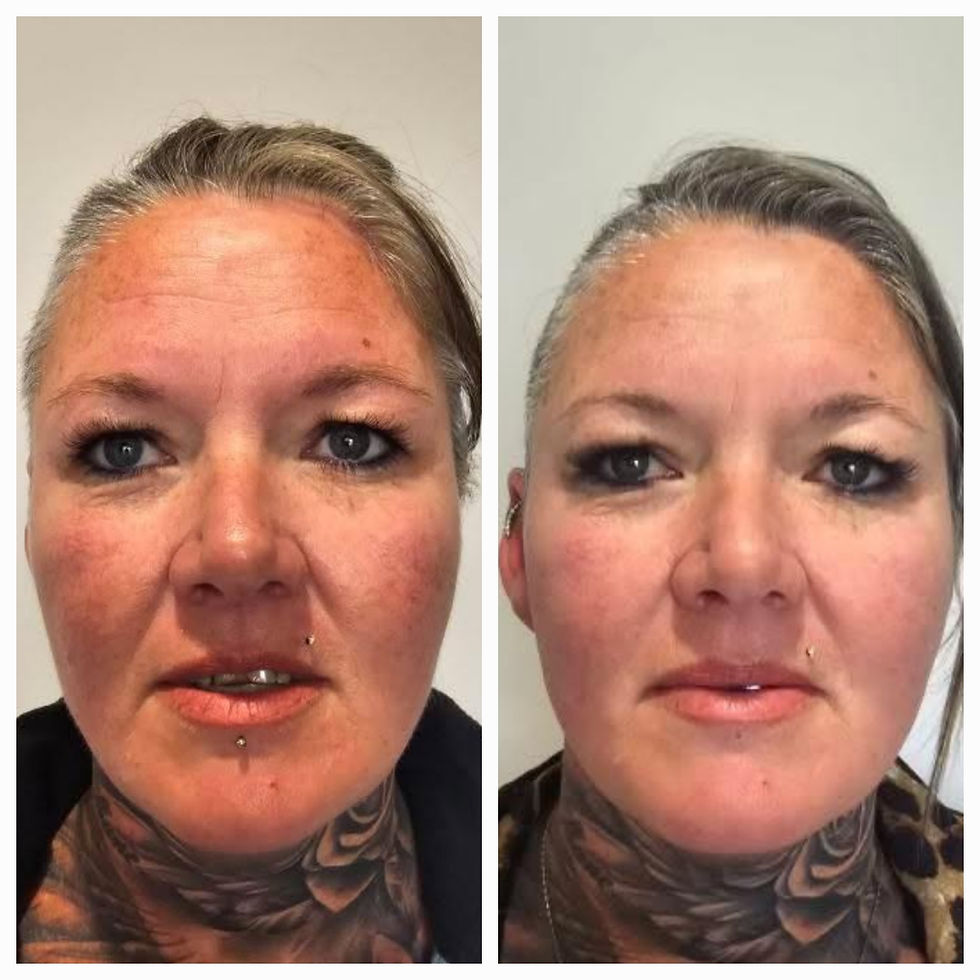 RESULT AFTER ONE SESSION 2 WEEKS LATER