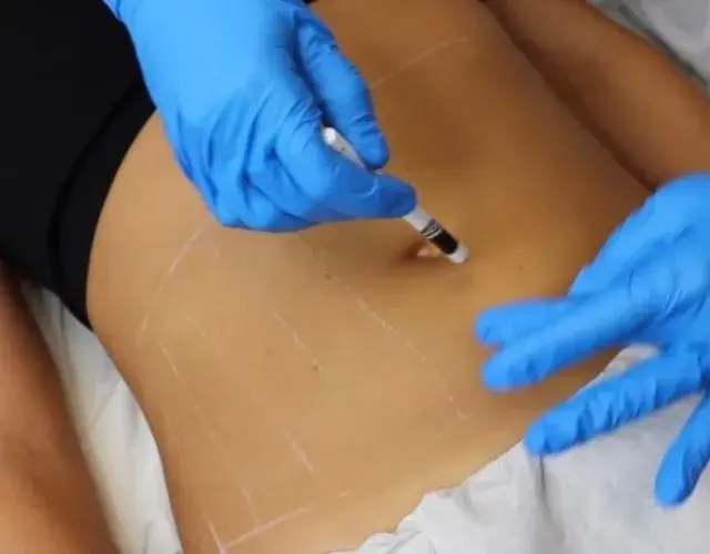 is lemon bottle fat dissolving permanent