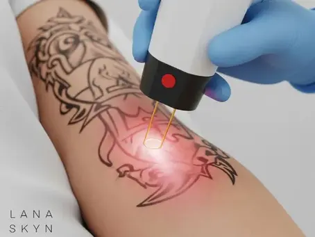 Can You Get a Tattoo Removed? It’s Easier Than You Think