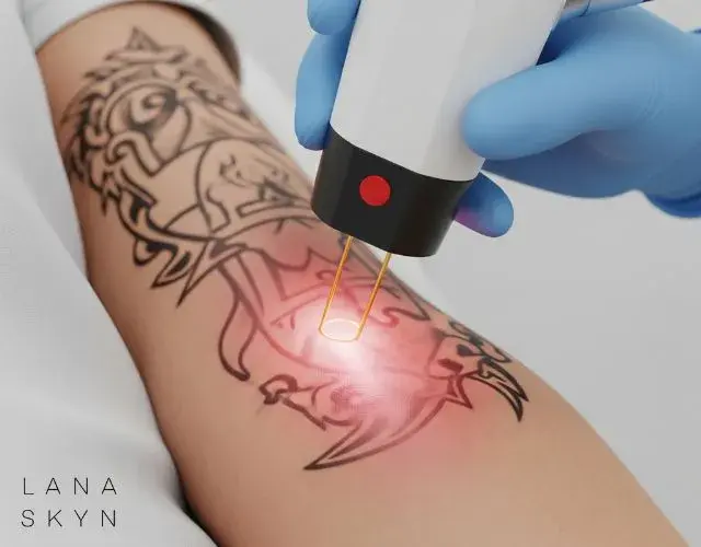 Can You Get a Tattoo Removed? It’s Easier Than You Think