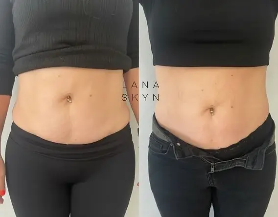 lemon bottle fat dissolver side effects Fat Dissolving Injections London main image 1