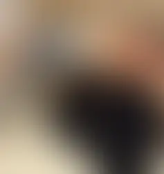 Hoe lang na laseren vallen haren uit?