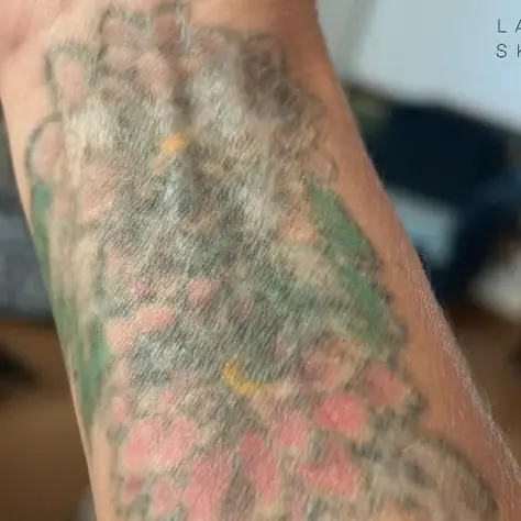 Remove a Large Tattoo: Common Challenges and How Experts Overcome Them