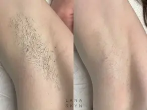 Hoe oksels op de juiste manier scheren voor langdurige gladheid