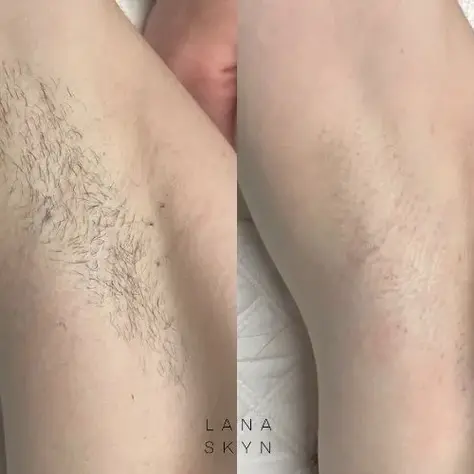 How to Shave Armpits the Right Way for Long-Lasting Smoothness