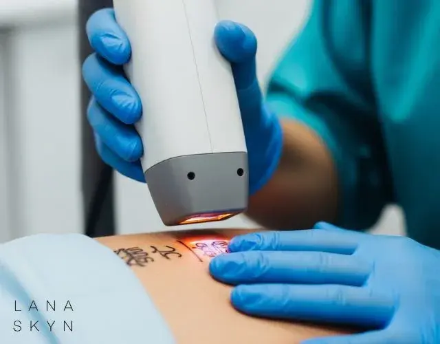 Kan een Nieuwe Tatoeage Worden Verwijderd? Dit Moet Je Weten Voor Je Te Snel Handelt