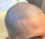 Scalp Micropigmentation and Creating a hard hairline for SMP