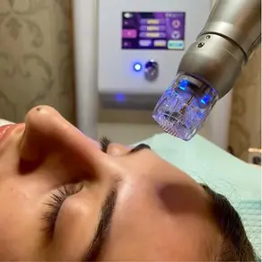 Why RF Microneedling is the Ultimate Skin Rejuvenation Treatment (And Why You Should Take Advantage of Our September Promotion)