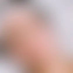 Ultra MD Burnaby | Lutronic Non-Ablative Fractional Laser | Prestige Laser