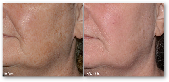 Rejuve+Medspa+_+LaseMD+Ultra+_+Laser+Skin+Resurfacing (1).png
