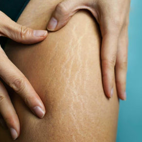 Understanding Stretch Marks and Effective Treatments at Prestige Laser & Skin Clinic