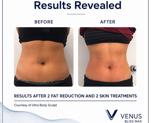 Before-and-after results of Venus Bliss MAX non-invasive fat reduction treatment on the abdomen