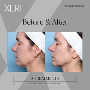 XERF Skin Tightening: The Non-Surgical Alternative to a Facelift in 2026