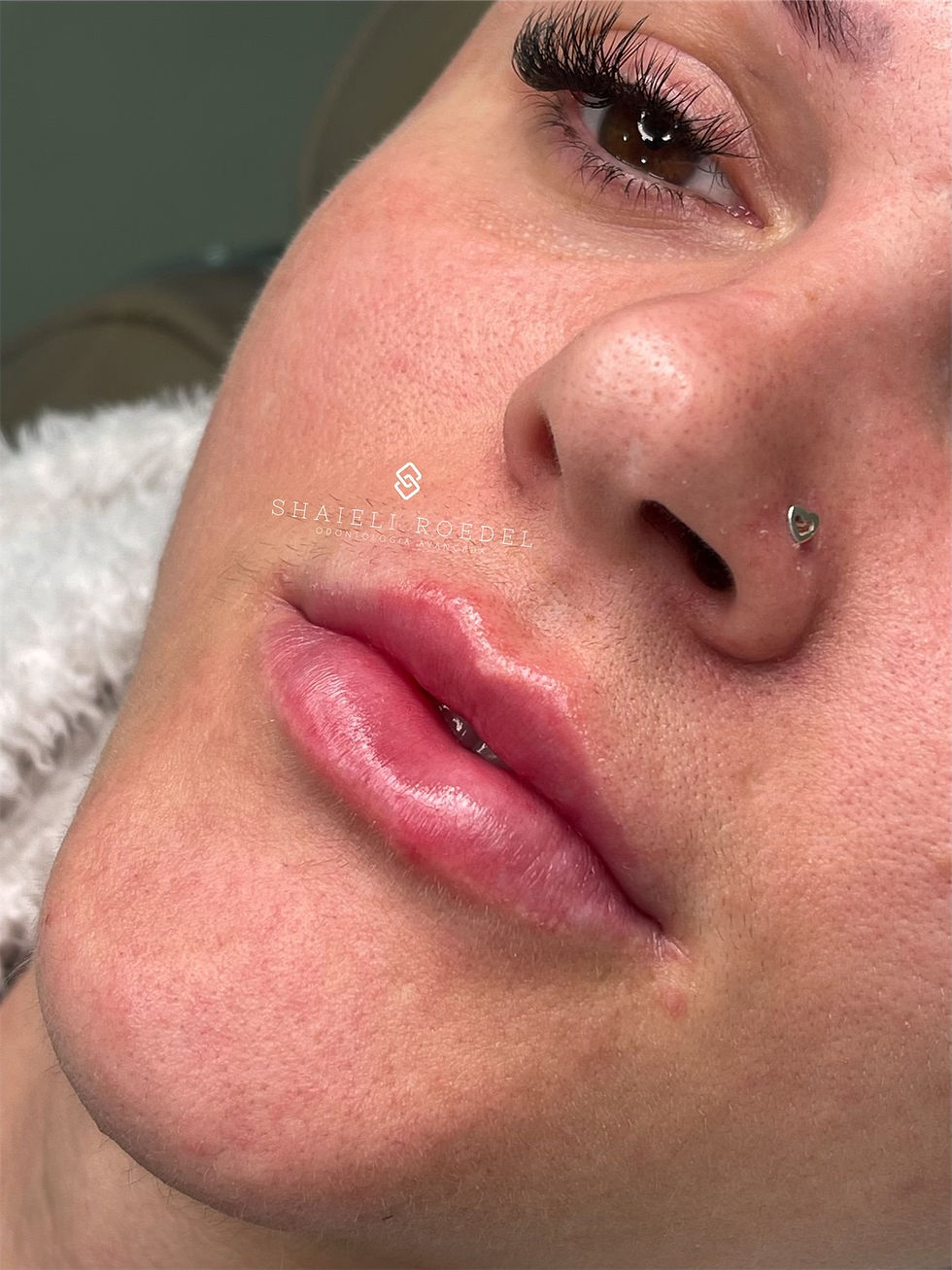 Procedimento de preenchimento labial