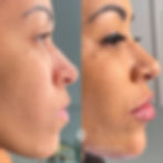 Procedimento de rinomodelação e preenchimento labial