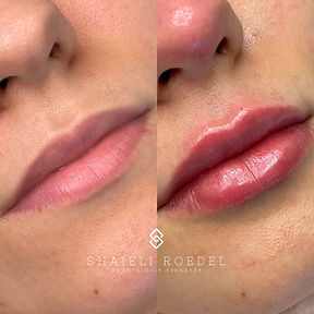 Antes e depois de um procedimento de preenchimento labial