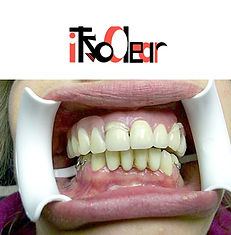 denture with clasps