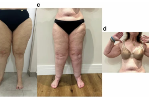 lipidema e alimentação