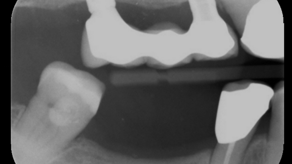 #3-5 implant bridge