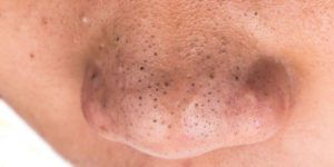 4 Different Types of Acne and How to Treat Them