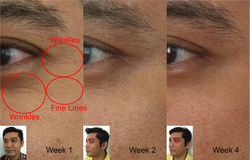 wrinkles reduced in 1 mth