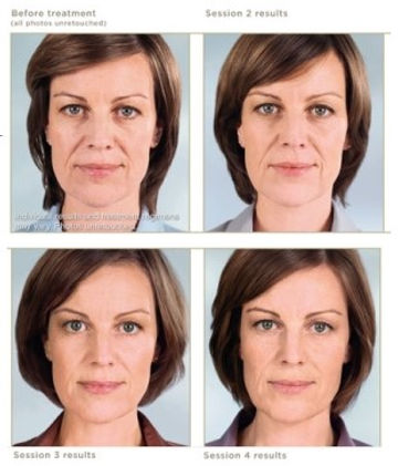Sculptra _beforeAfter.jpg