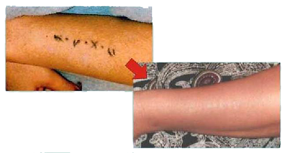 Rejuvi Tattoo Removal Brigi Beauty Sanford Fl