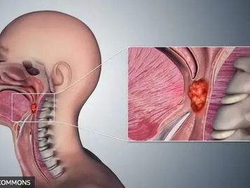 Saiba a relação entre o câncer de garganta e o sexo desprotegido