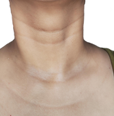 necklace lines behandling i Bergen