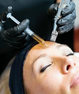 Meso needling i Bergen
