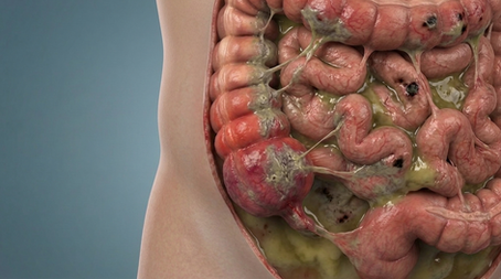 Peritonitis: Por qué cada minuto cuenta en una emergencia abdominal